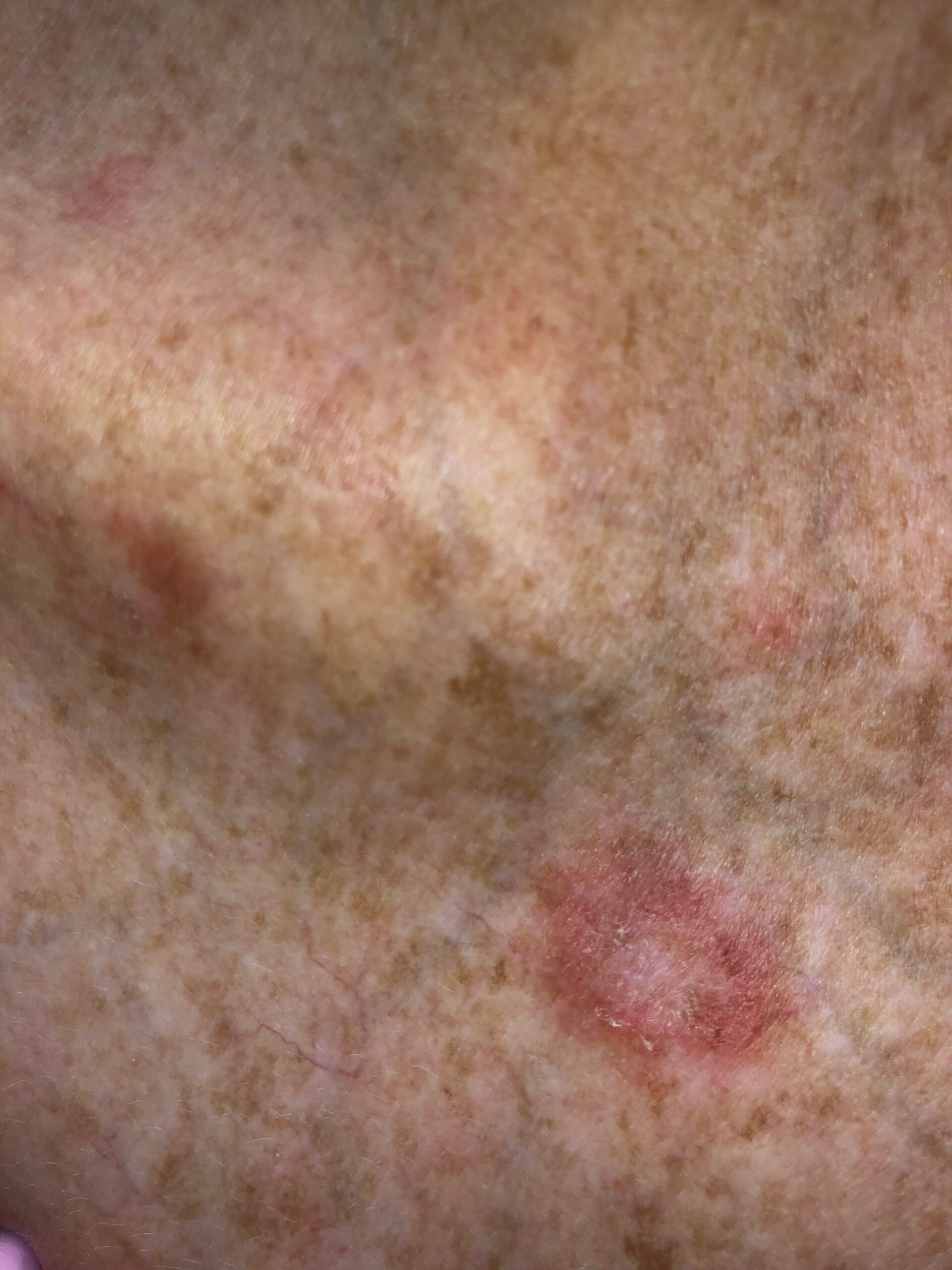 Discoid lupus on the chest of a white woman Saphelo for lupus