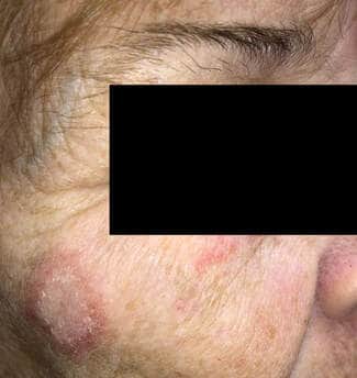 Discoid lupus erythematosus on the cheek of a white woman with systemic lupus