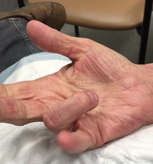 A man with trigger finger due to tenosynovitis