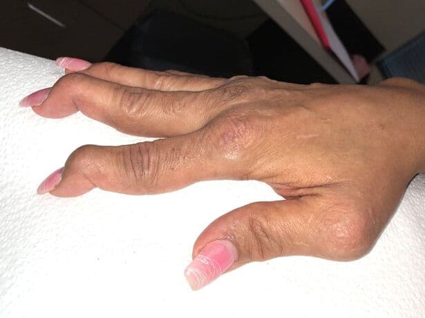 A lupus patient with Jaccoud