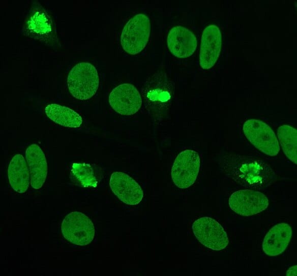 Microscopic view of a positive fluorescent antinuclear antibody test used to diagnose a lupus patient