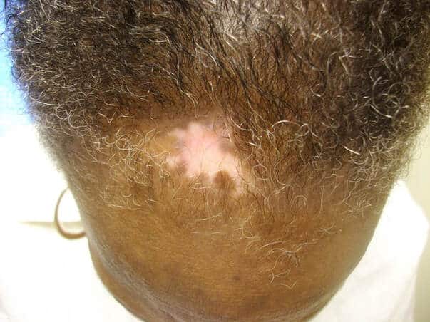 Discoid lupus causing scarring alopecia