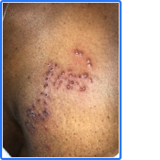 Shingles (herpes zoster) in one of my lupus patients. Patients with lupus and vaccines