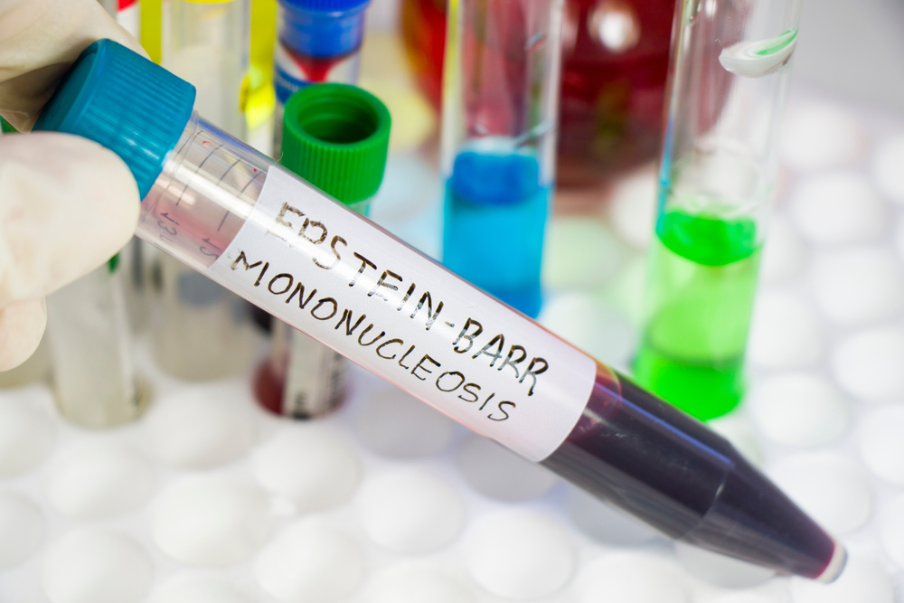 blood test for Epstein Barr virus and mononucleosis