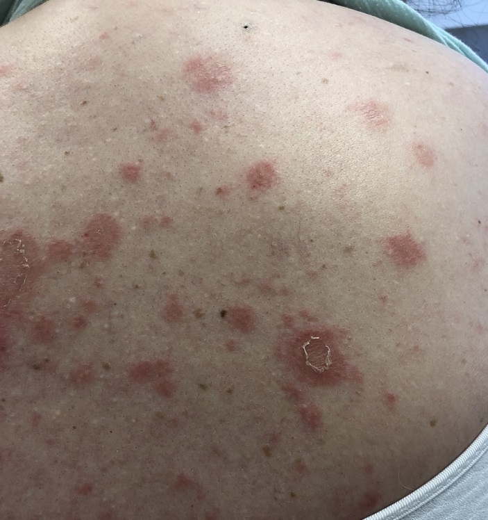 Proton pump inhibitor induced subacute cutaneous lupus on upper back of woman with systemic lupus erythematosus