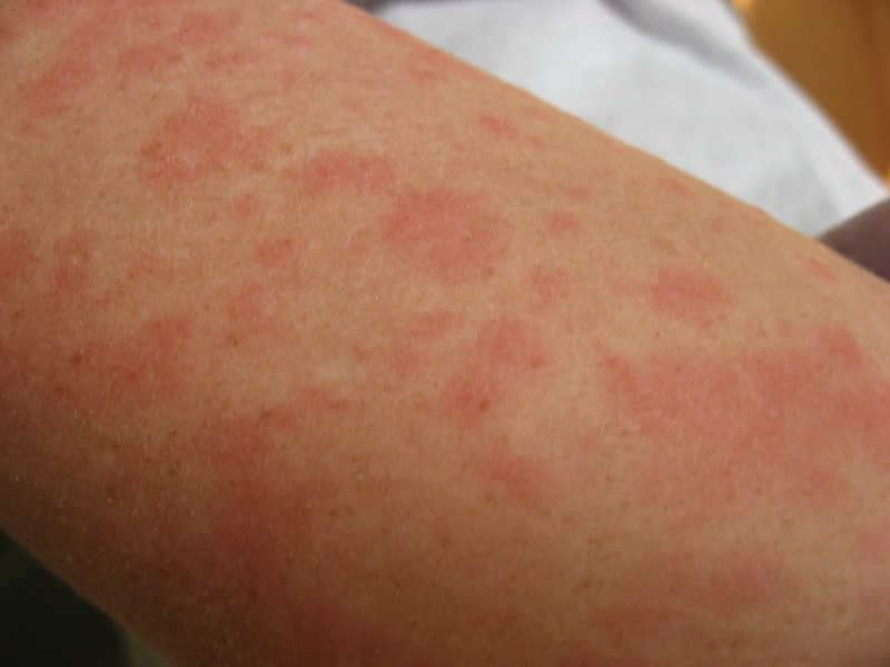 Lupus and hives on arm