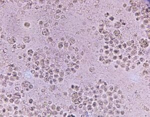 White blood cells in urine or pyuria