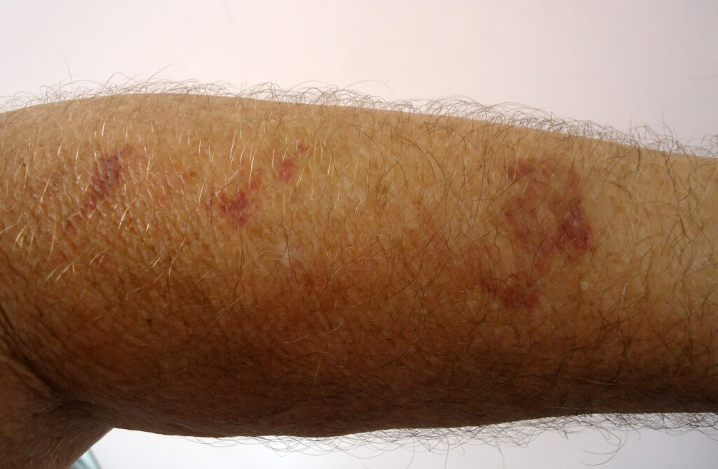 Lupus and purple spot