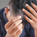 Hair and Skin Problems in Lupus